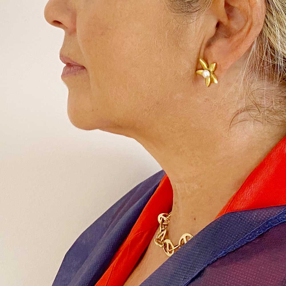 liposucción-papada