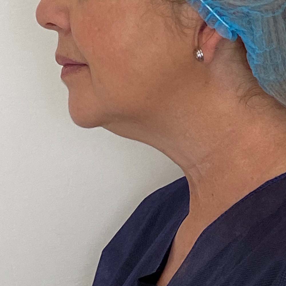 liposucción-papada-antes