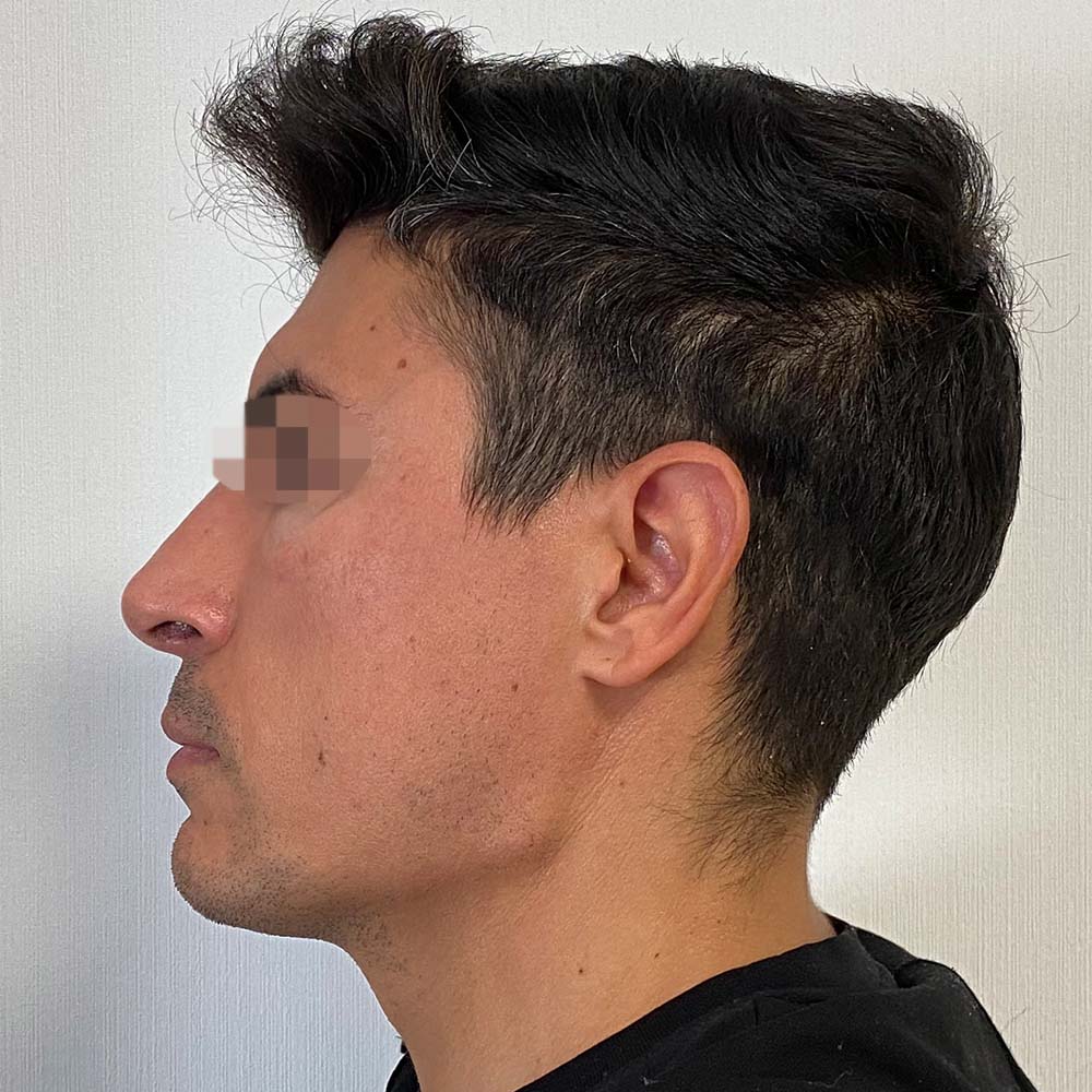 angulos-mandibulares-despues