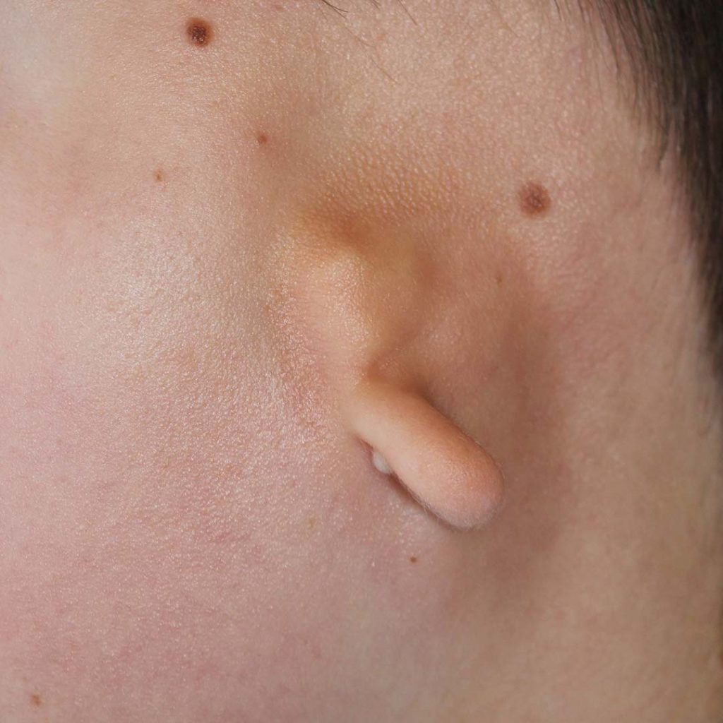 reconstruccion-auricular-microtia