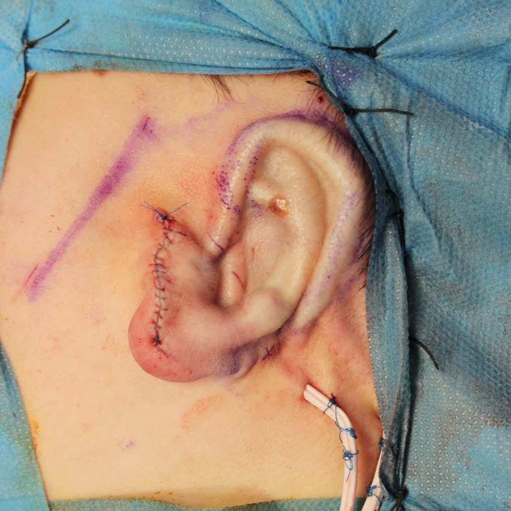reconstruccion-auricular-despues