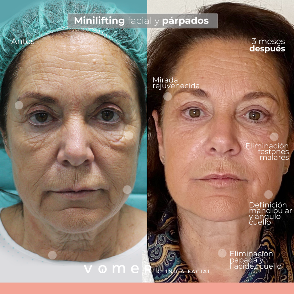 minilifting-facial