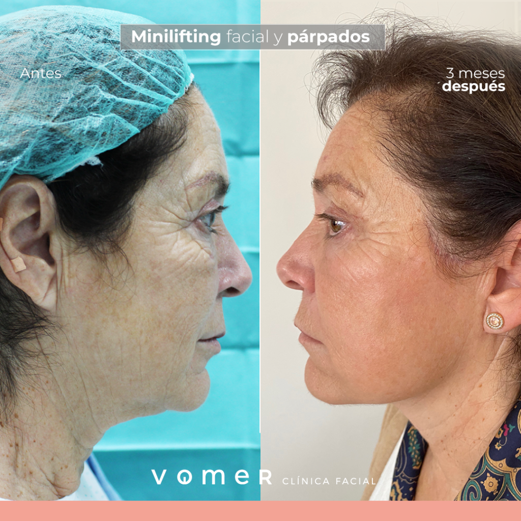 minilifting-facial