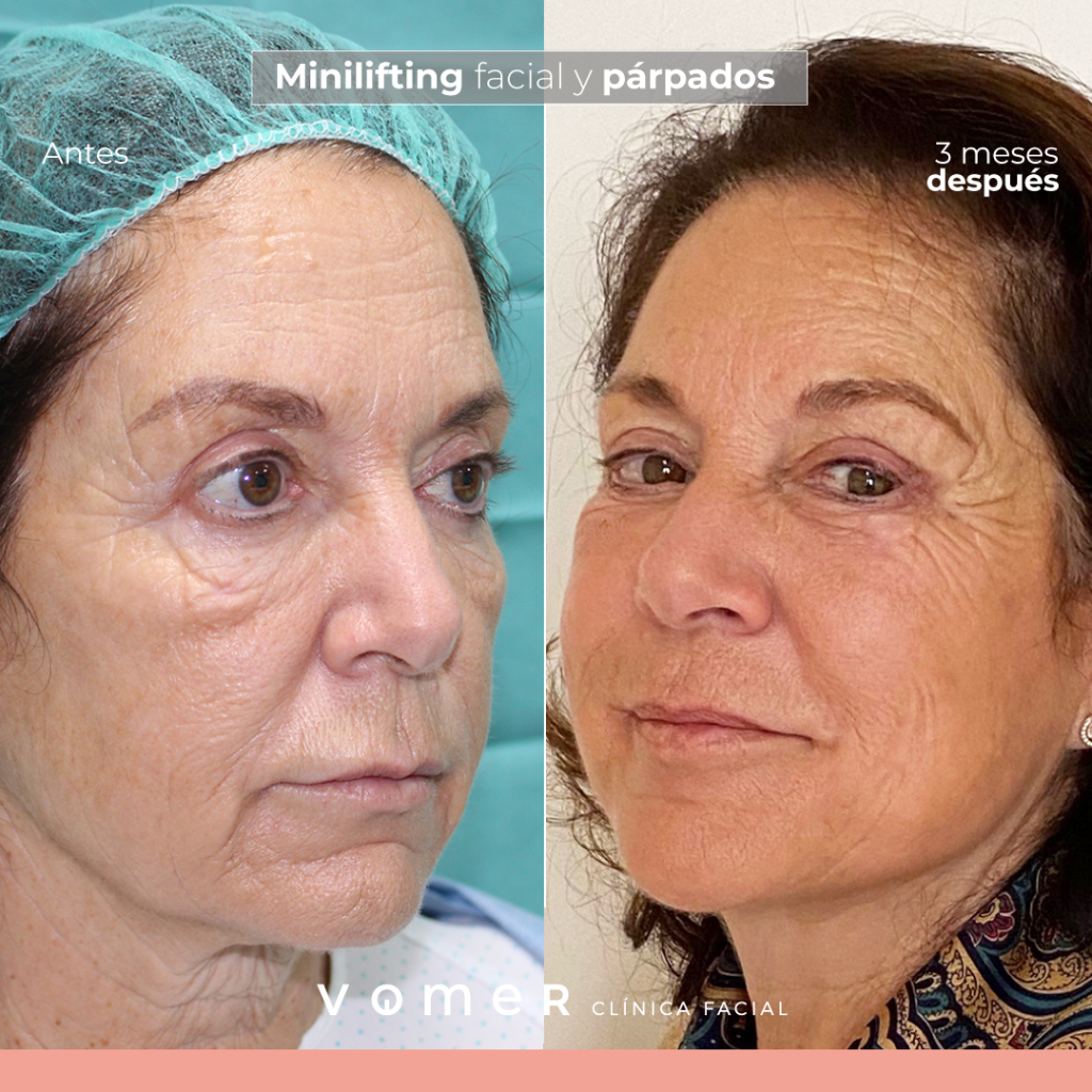 minilifting-facial