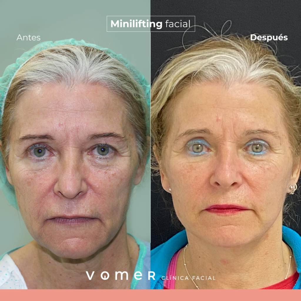 minilifting-facial