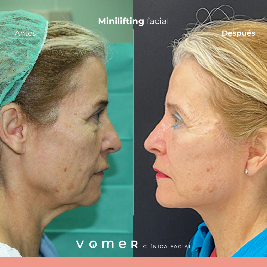 minilifting-facial