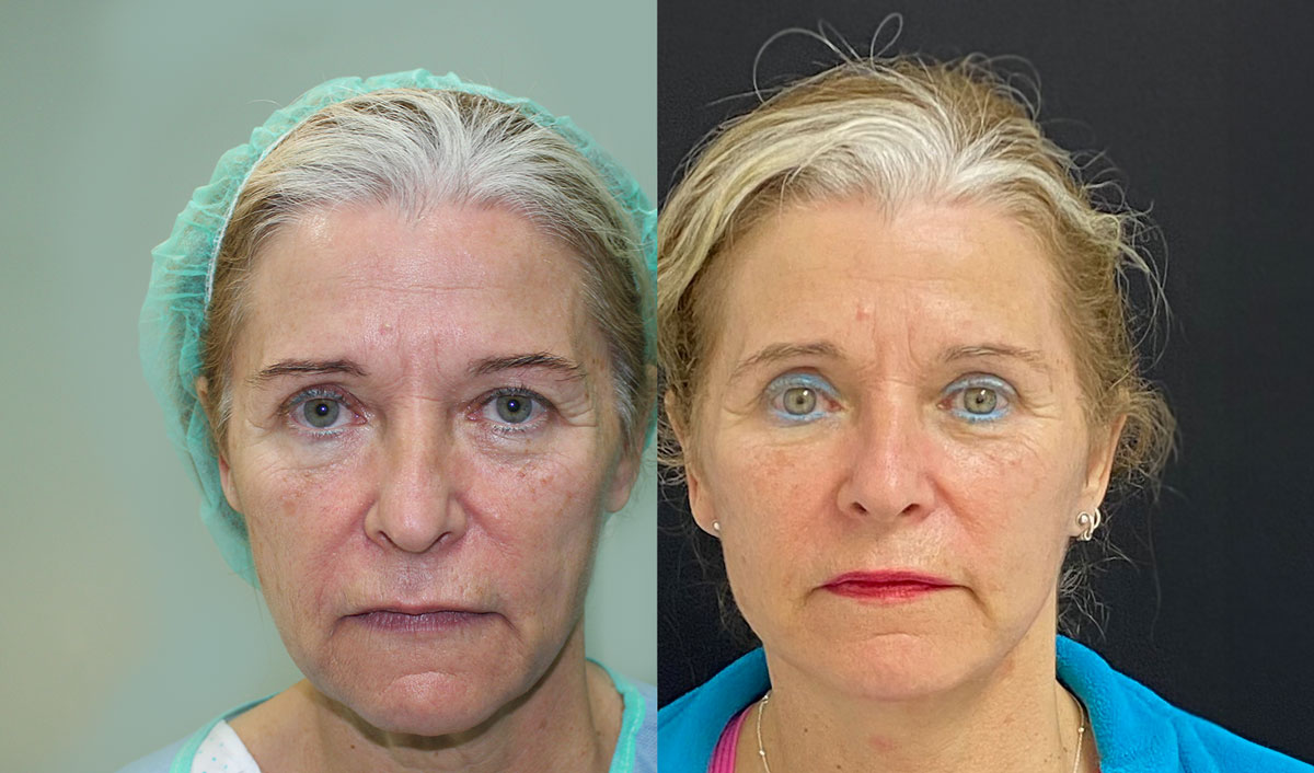 minilifting-facial-portada