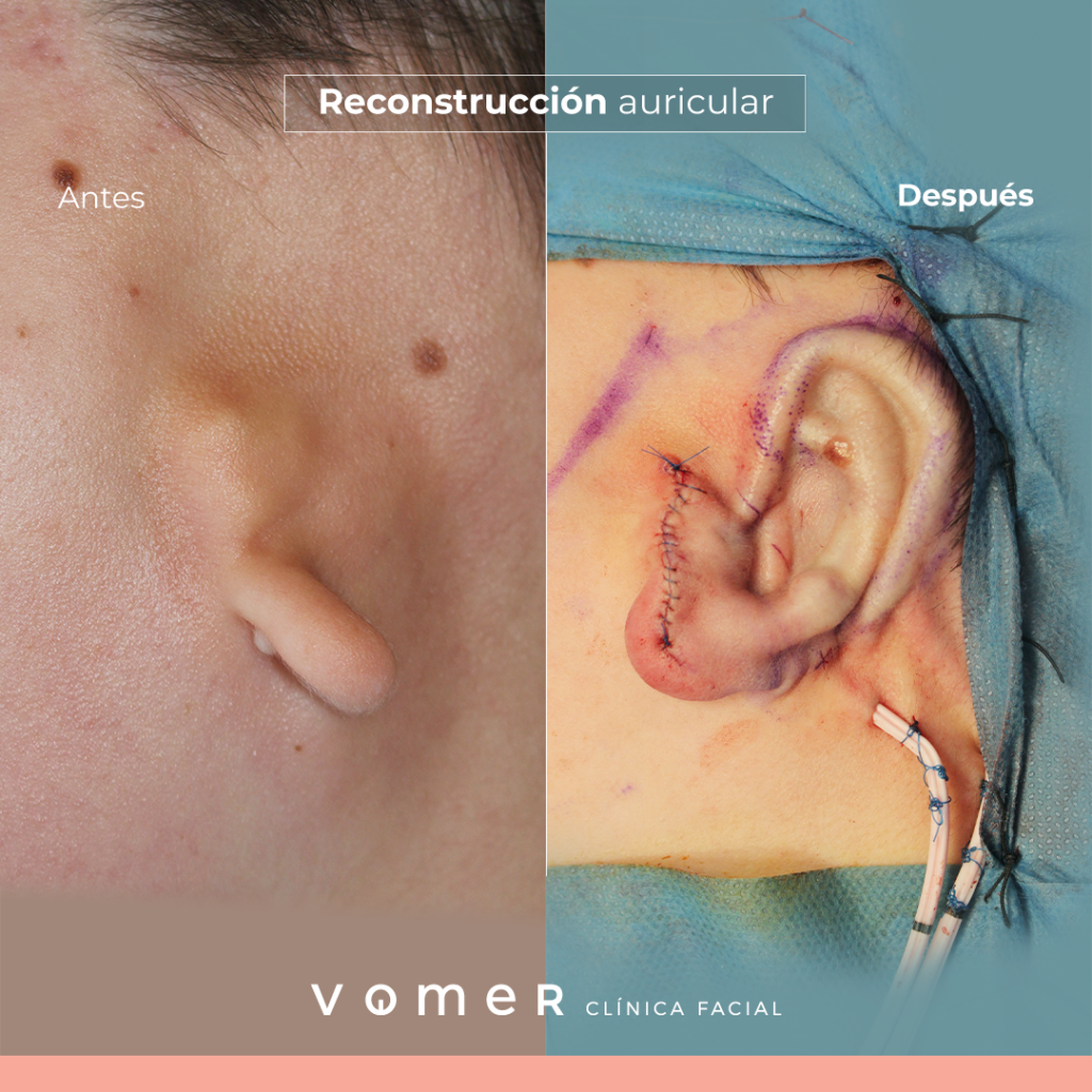 reconstruccion-microtia