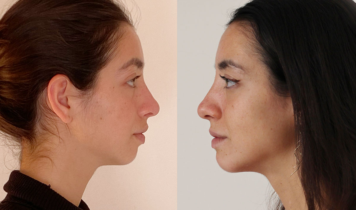 mentoplastia-ultrasonica