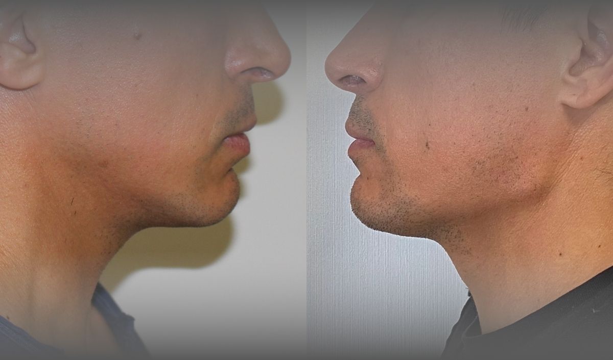 angulos-mandibulares