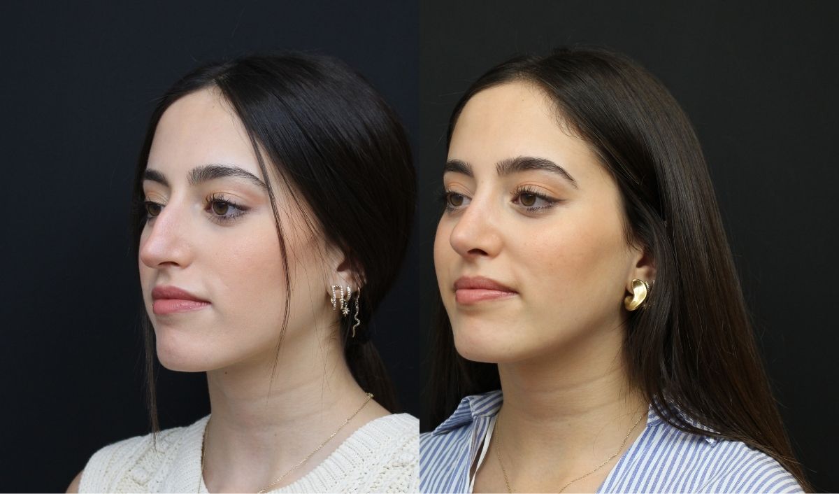 rinoplastia-clinica-vomer