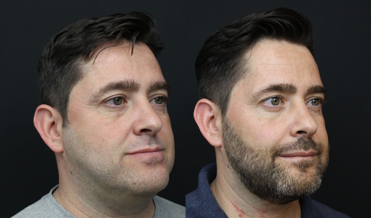 prognatismo-mandibular