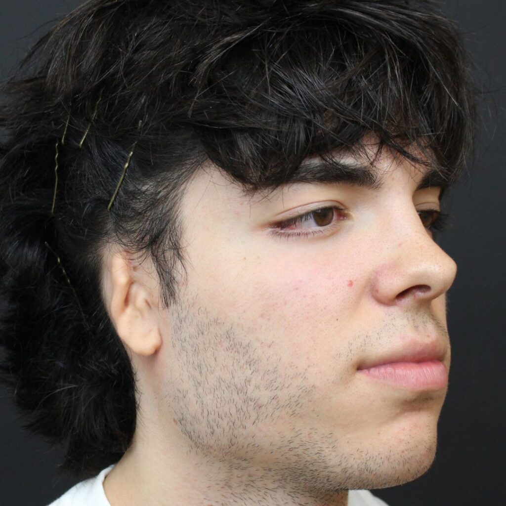 reconstruccion auticular microtia