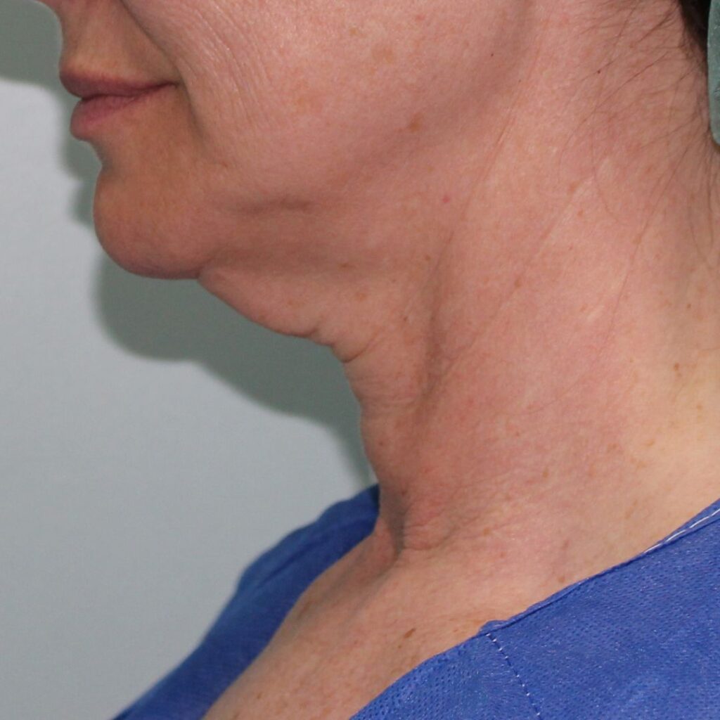 minilifting facial 2 antes