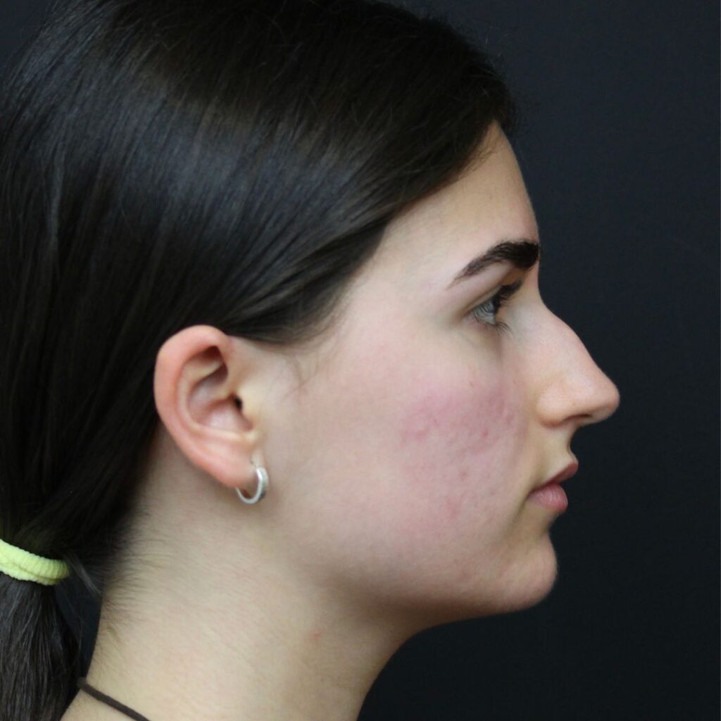 rinoplastia ultrasonica 23 antes