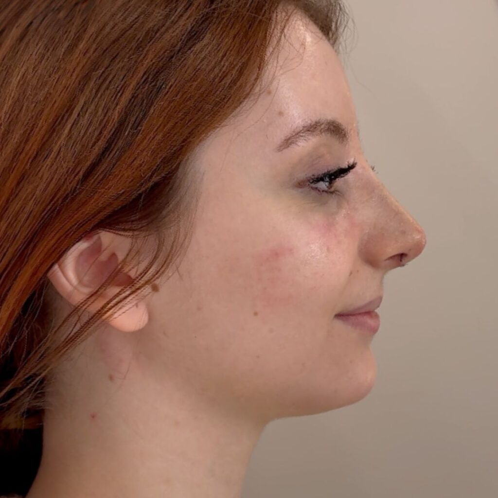 rinoplastia ultrasonica 57 despues