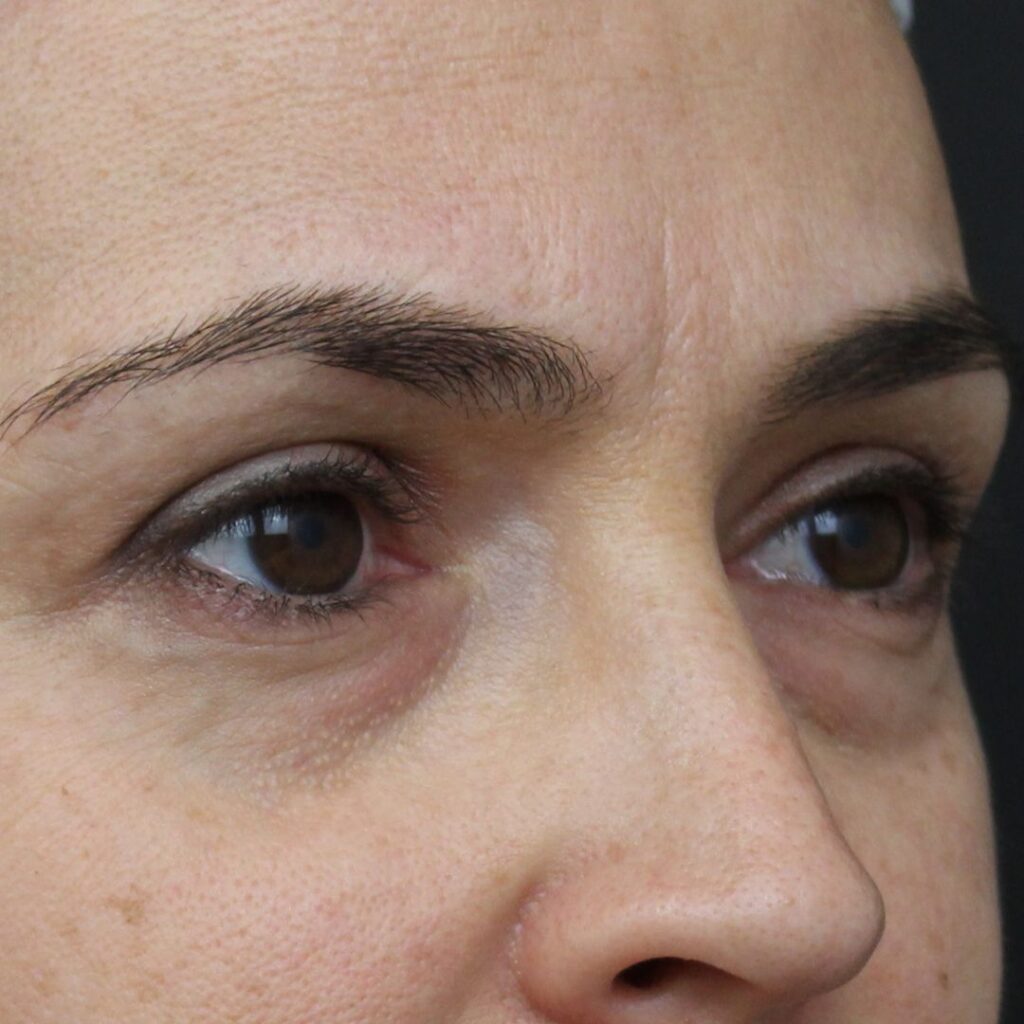 blefaroplastia 30 antes