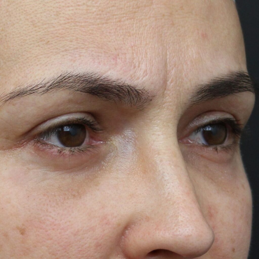 blefaroplastia 30 despues