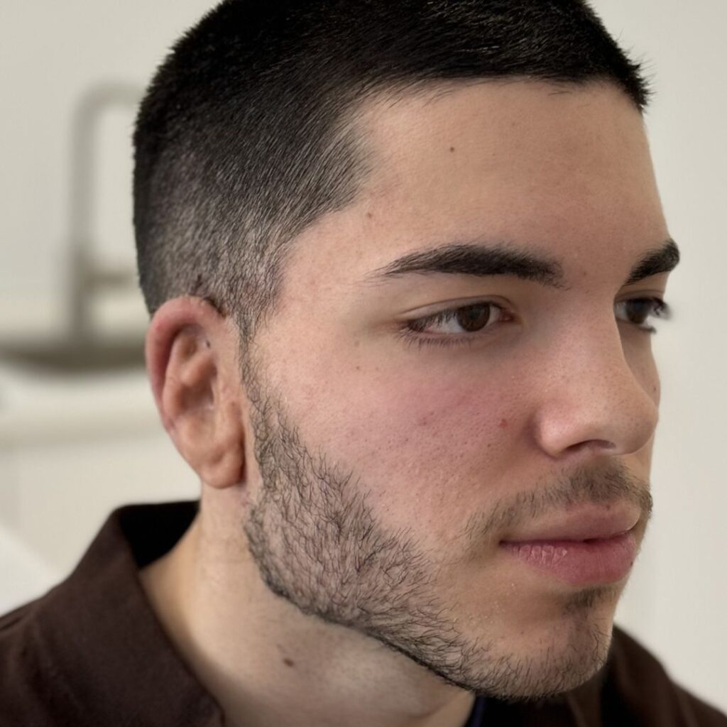 reconstruccion auticular microtia