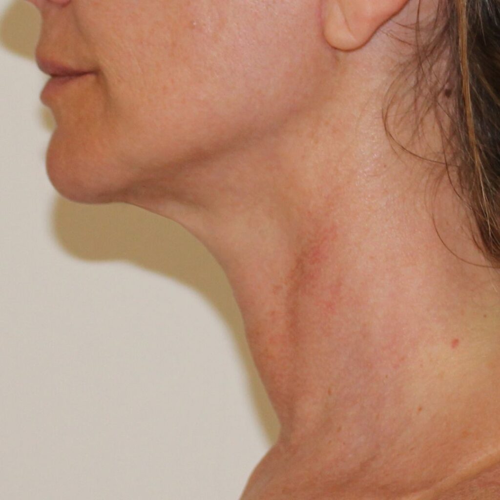 minilifting facial 2 despues