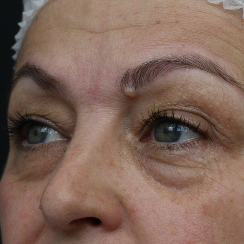 blefaroplastia 29 antes