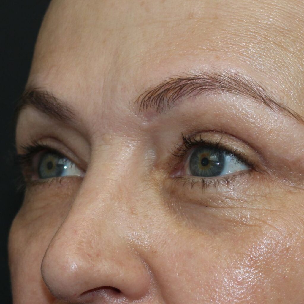 blefaroplastia 29 despues
