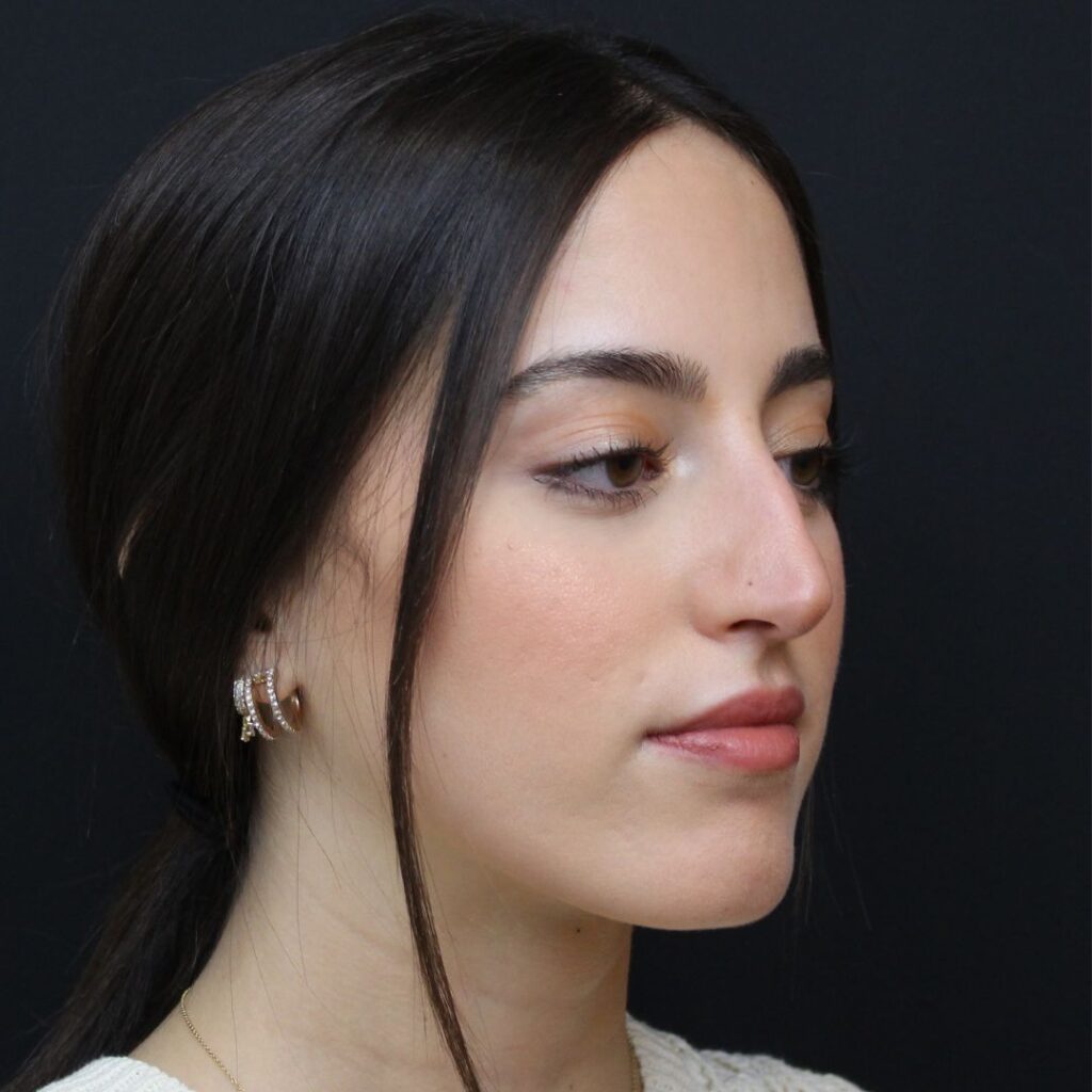 rinoplastia ultrasonica 18 antes