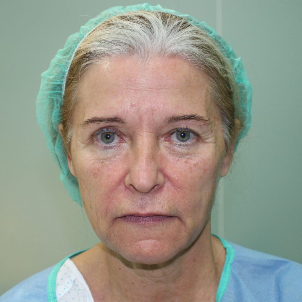 minilifting facial 3 antes