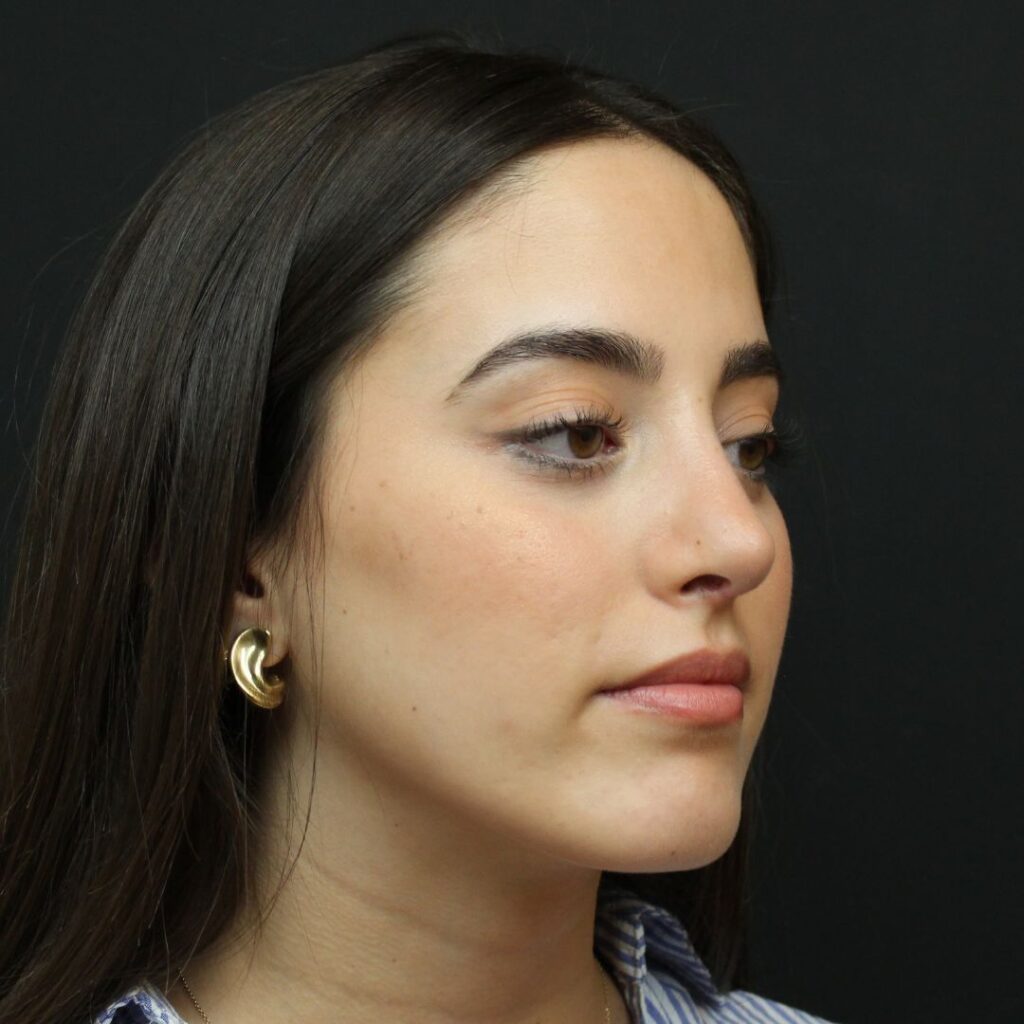 rinoplastia ultrasonica 18 despues