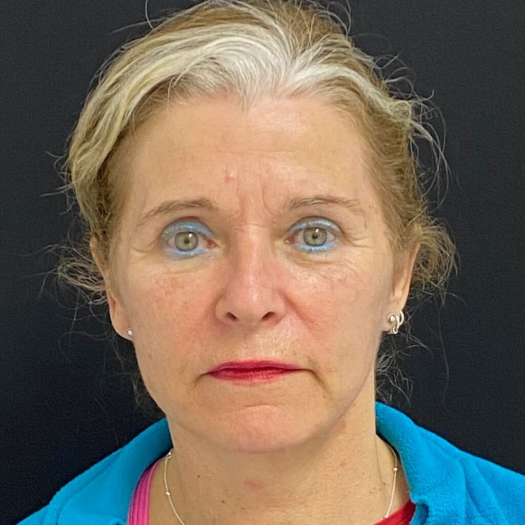 minilifting facial 3 despues