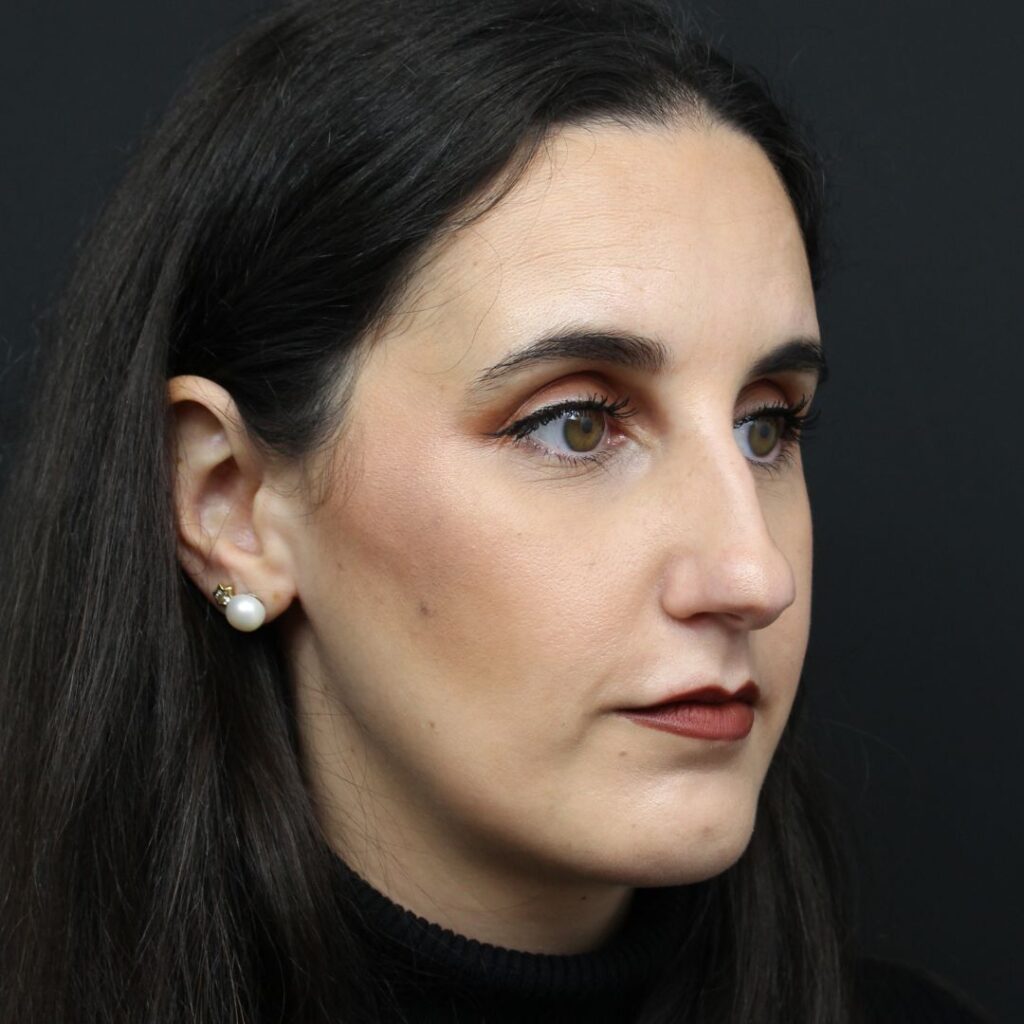 rinoplastia ultrasonica 14 antes