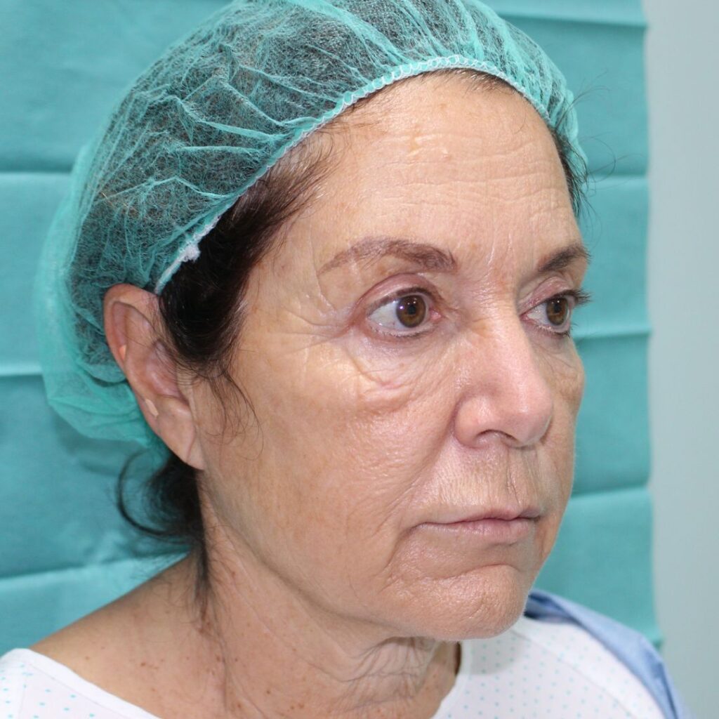 minilifting facial 4 antes