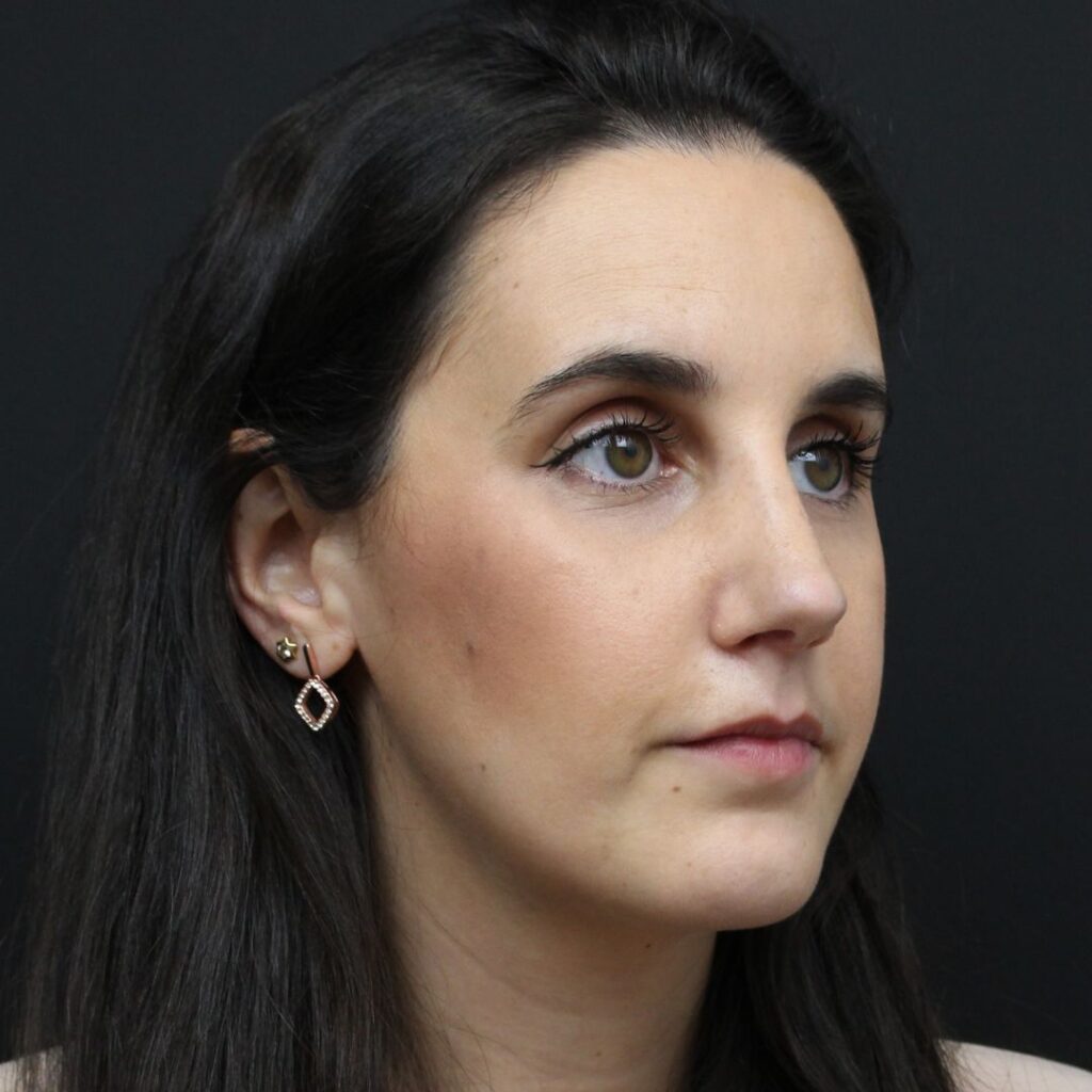 rinoplastia ultrasonica 14 despues