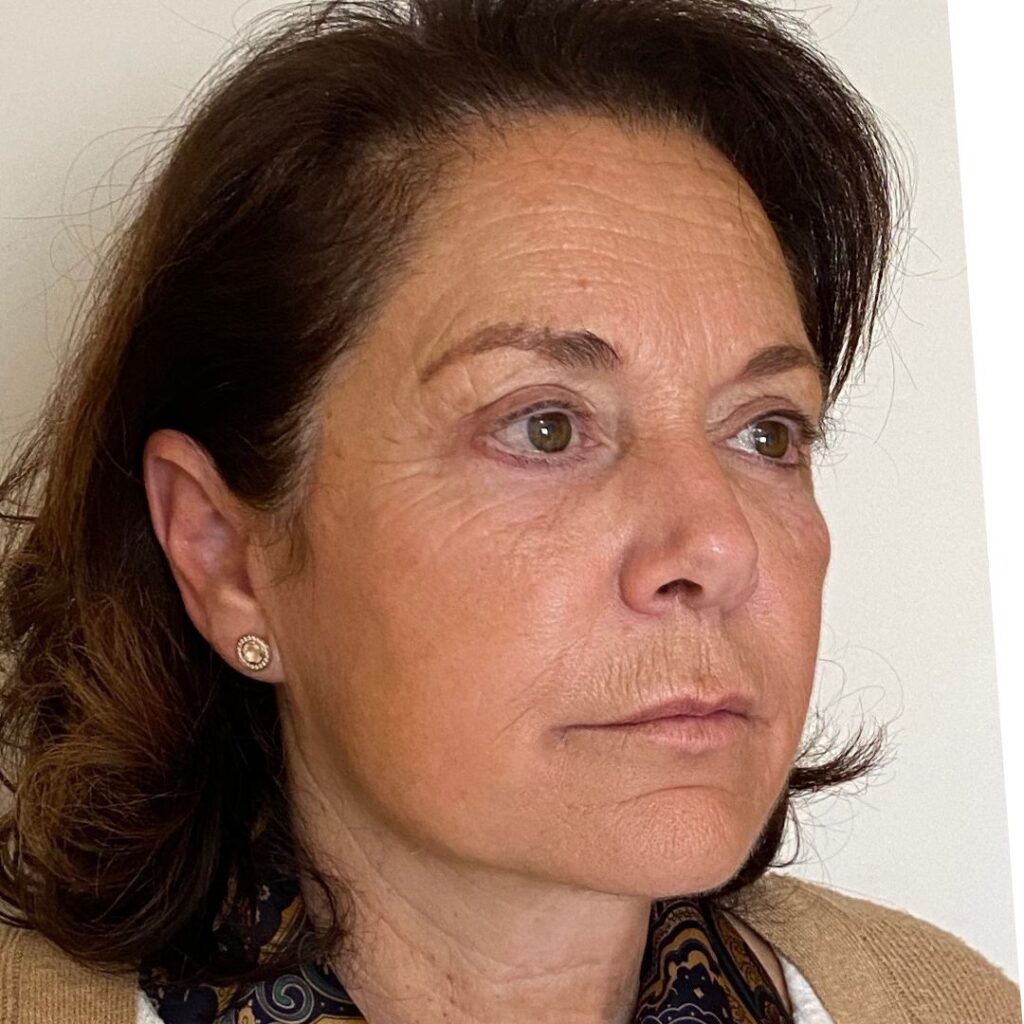 minilifting facial 4 despues