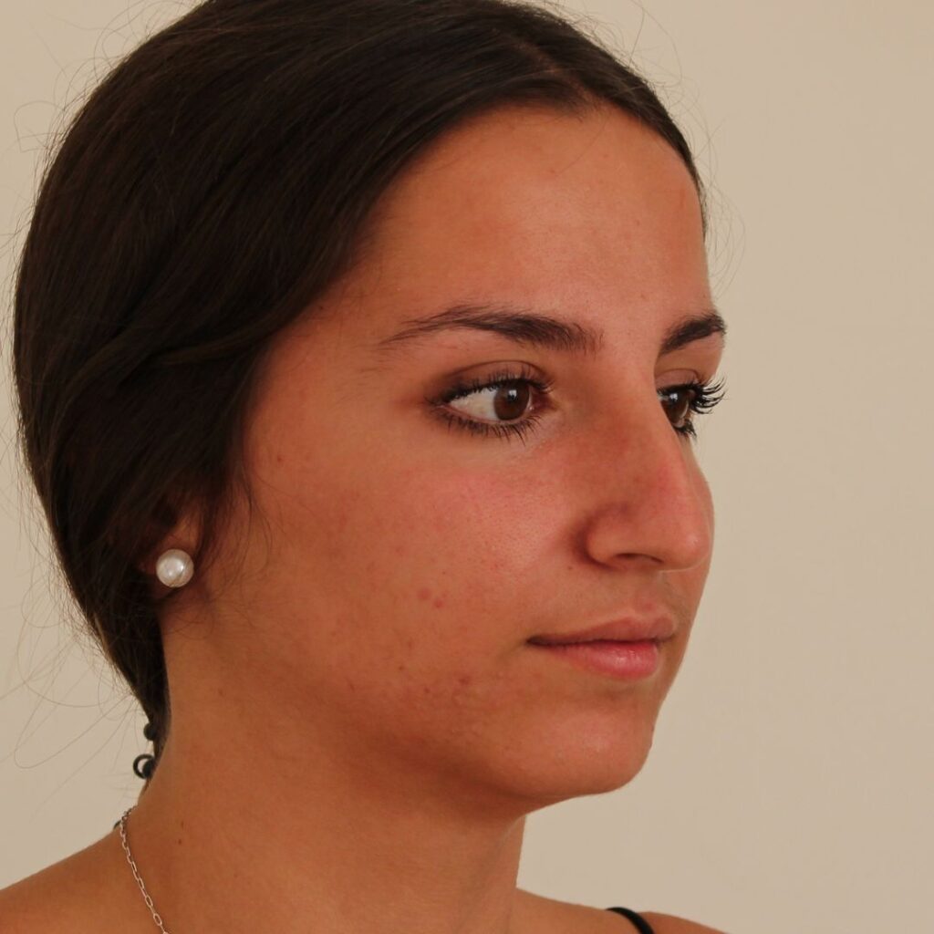 rinoplastia ultrasonica 7 antes