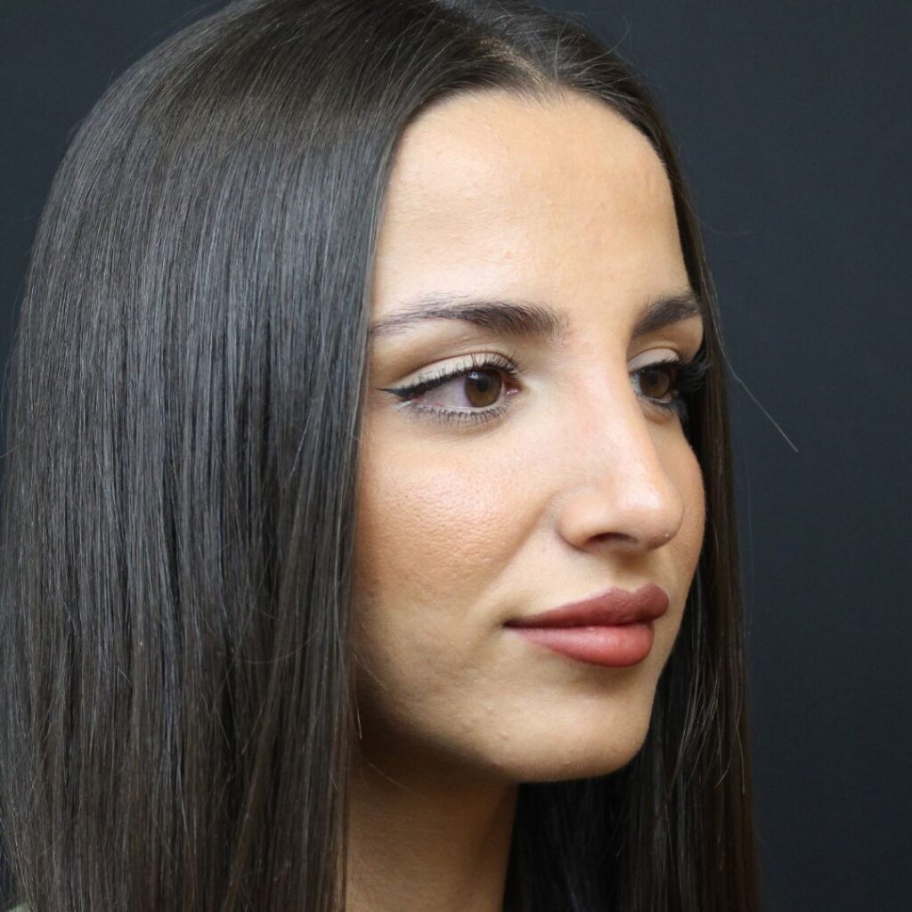 rinoplastia ultrasonica 7 despues