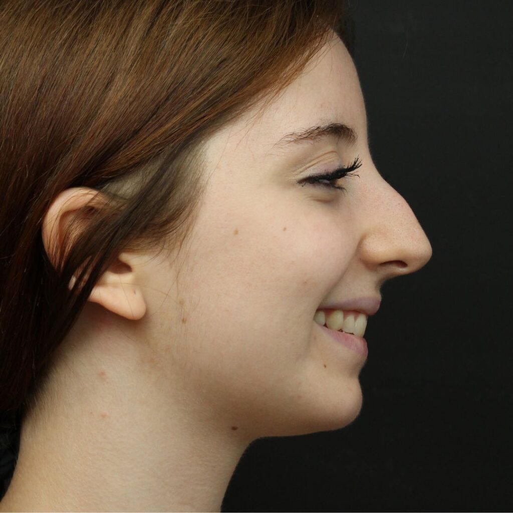 rinoplastia ultrasonica 57 antes