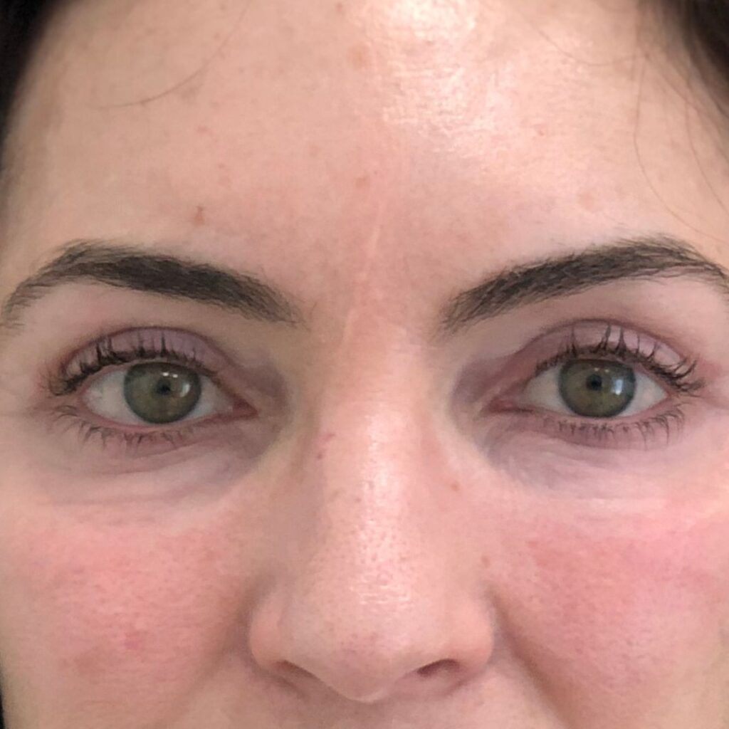 blefaroplastia 8 despues