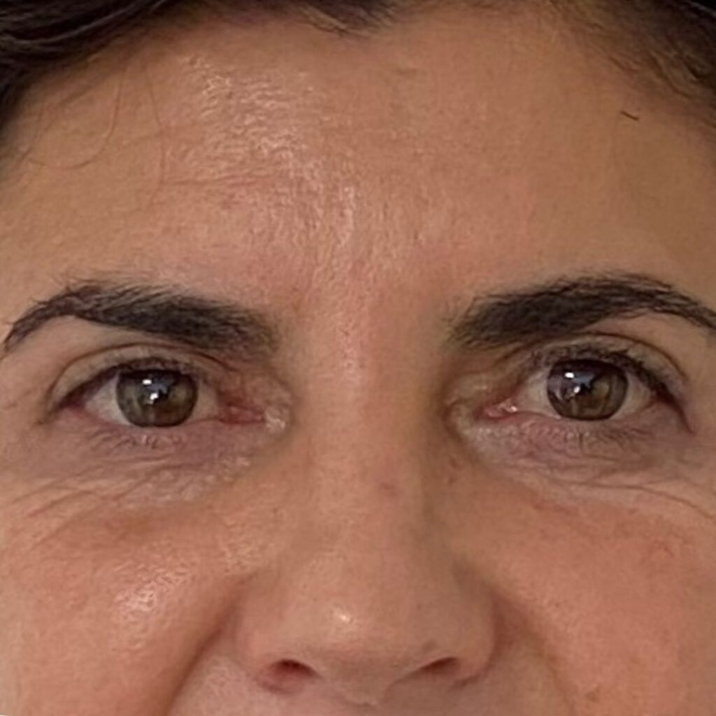 blefaroplastia 6 despues