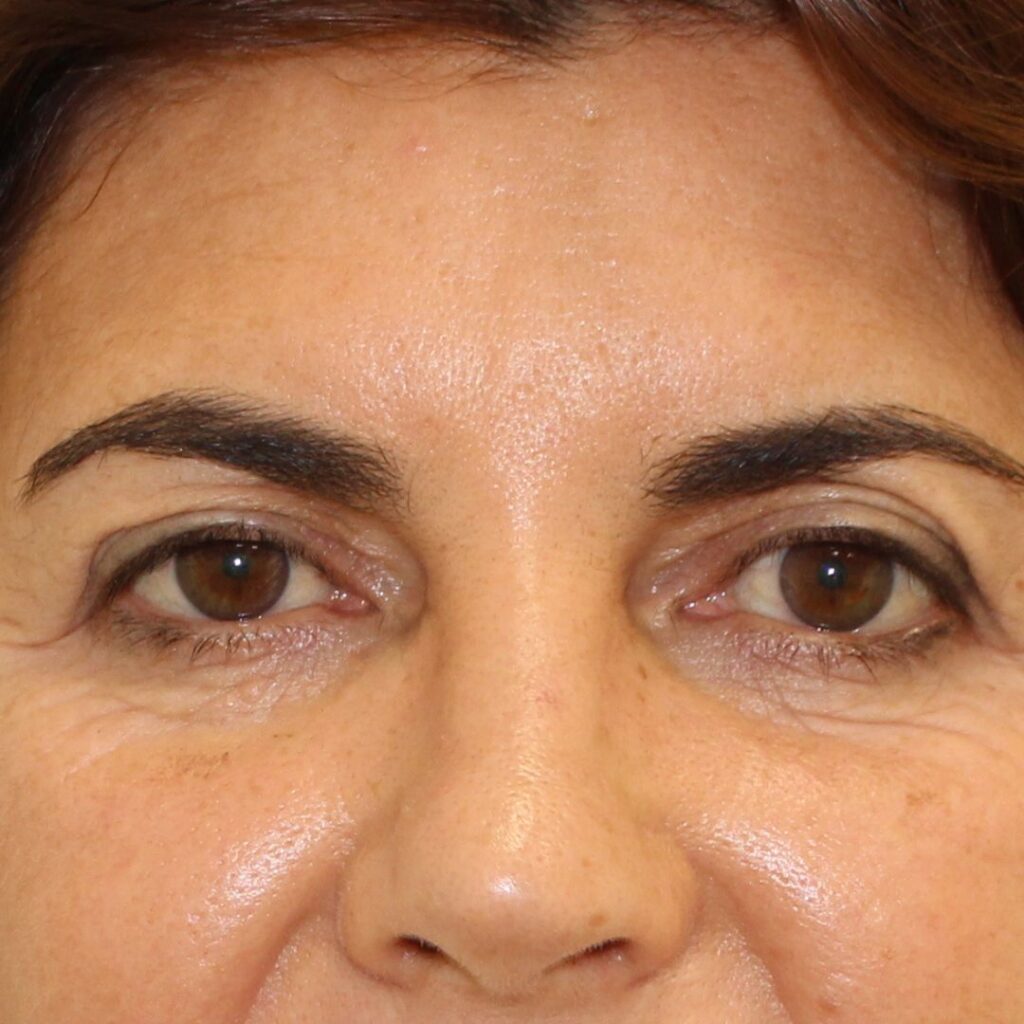 blefaroplastia 6 antes