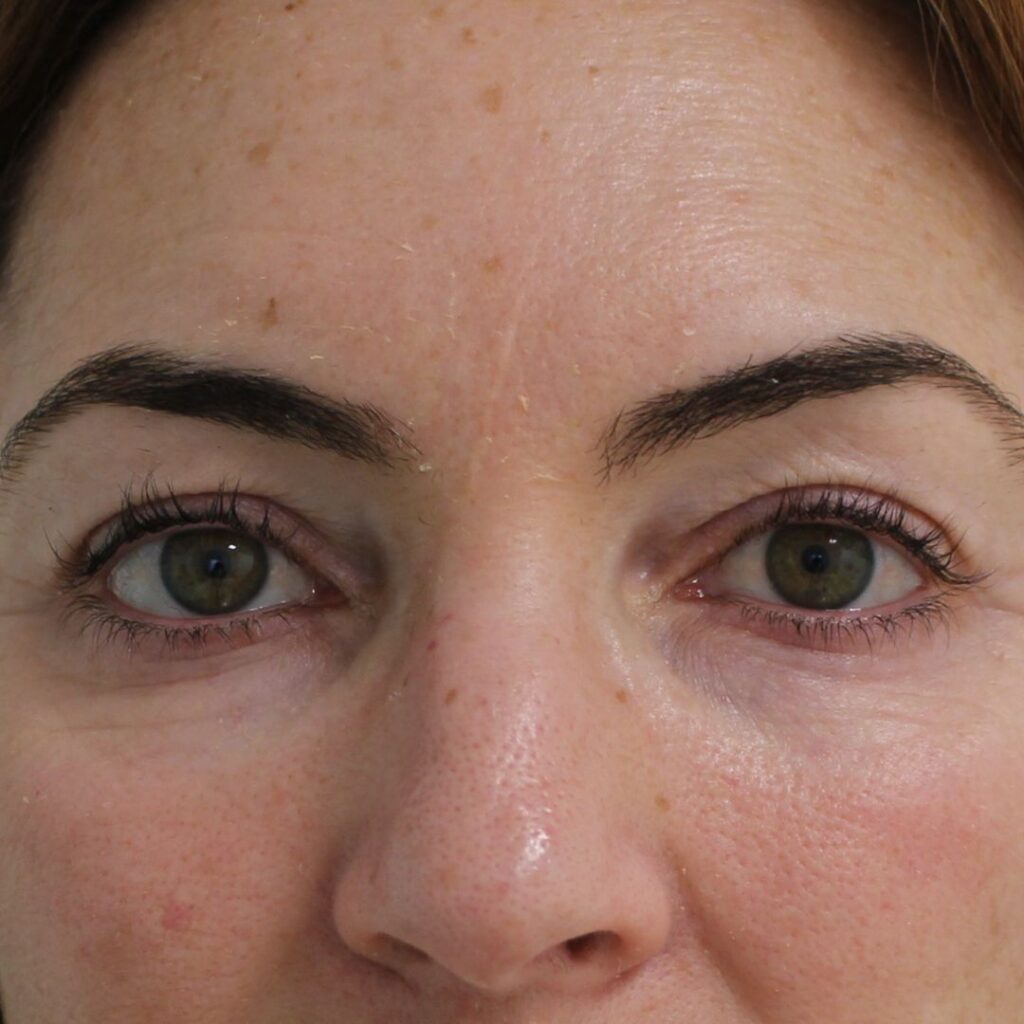 blefaroplastia 8 antes
