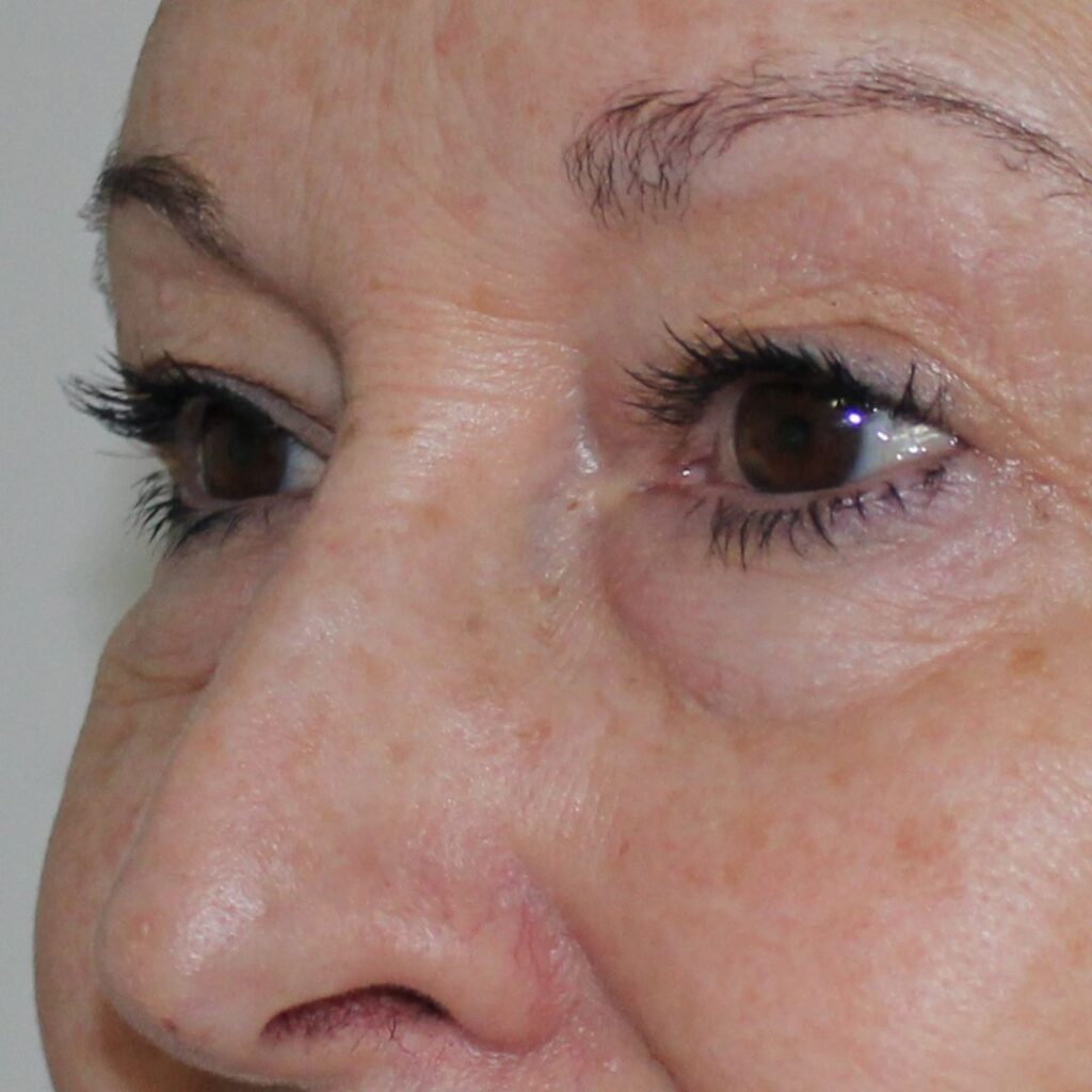 blefaroplastia 2 antes