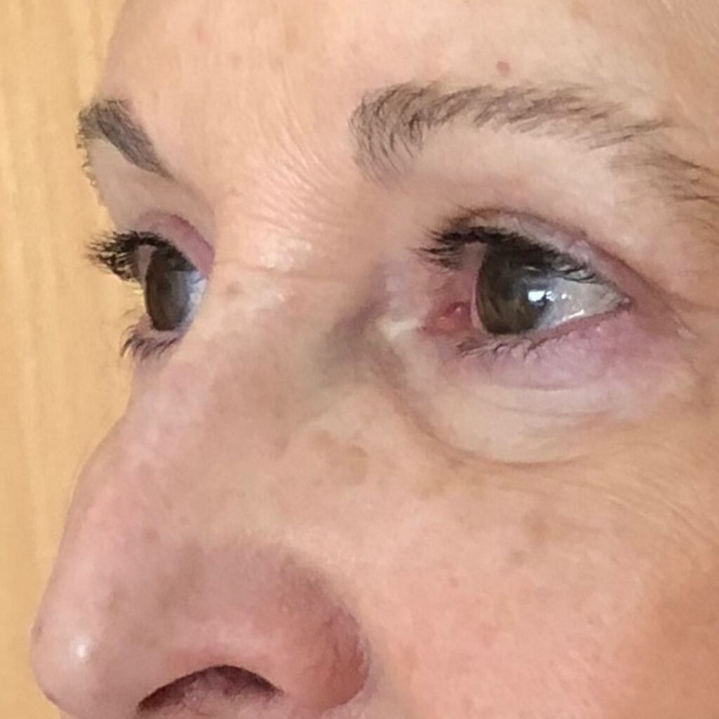 blefaroplastia 2 despues