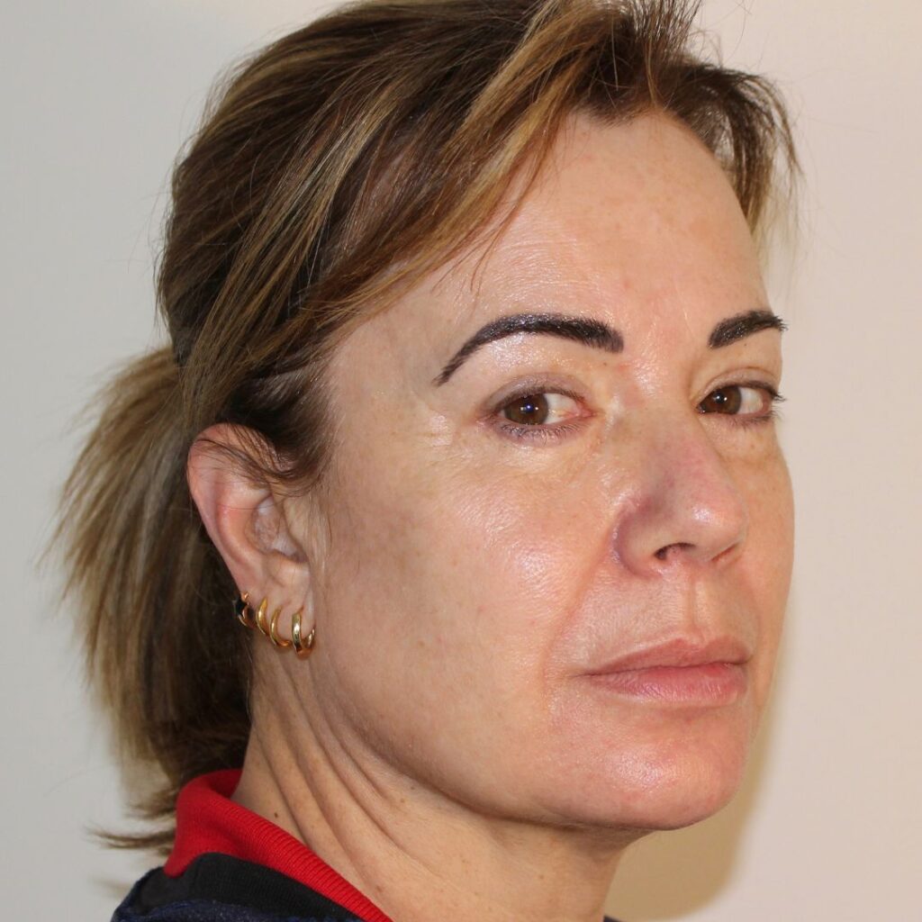 blefaroplastias 3 despues