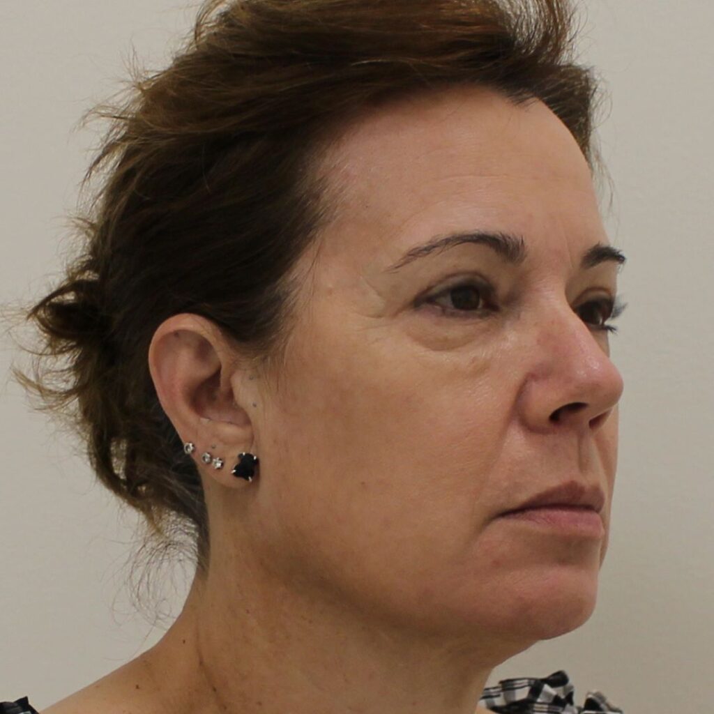 blefaroplastias 3 antes