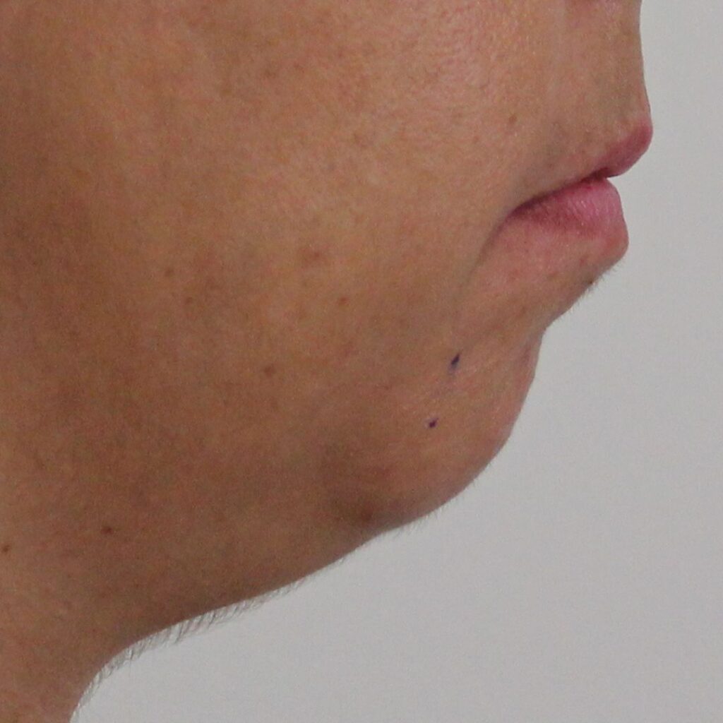 mentoplastia 3 antes