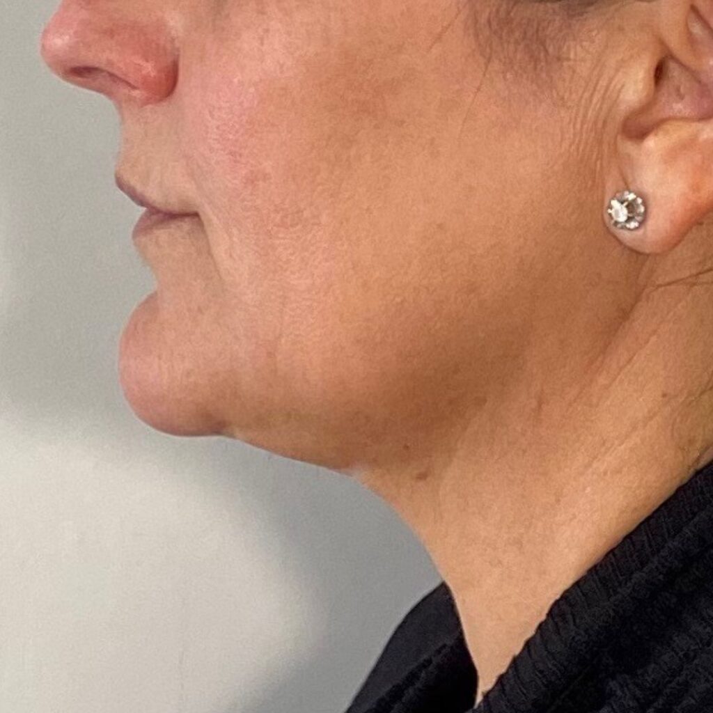 liposuccion de papada 2 despues