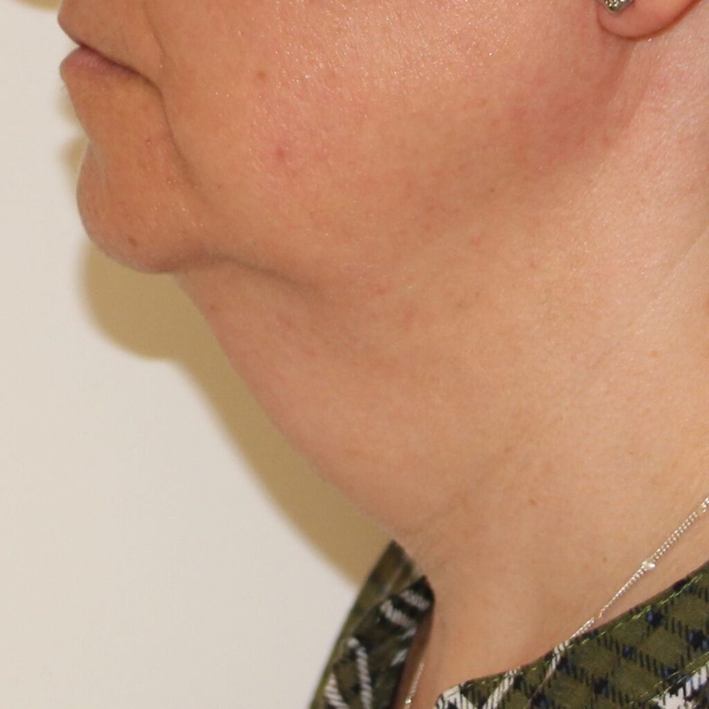 liposuccion de papada 3 antes