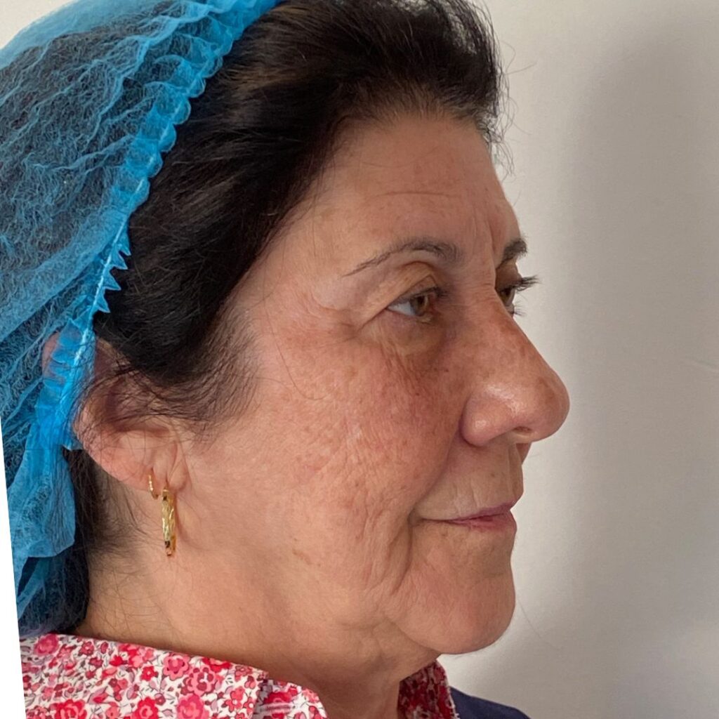 blefaroplastia 9 antes