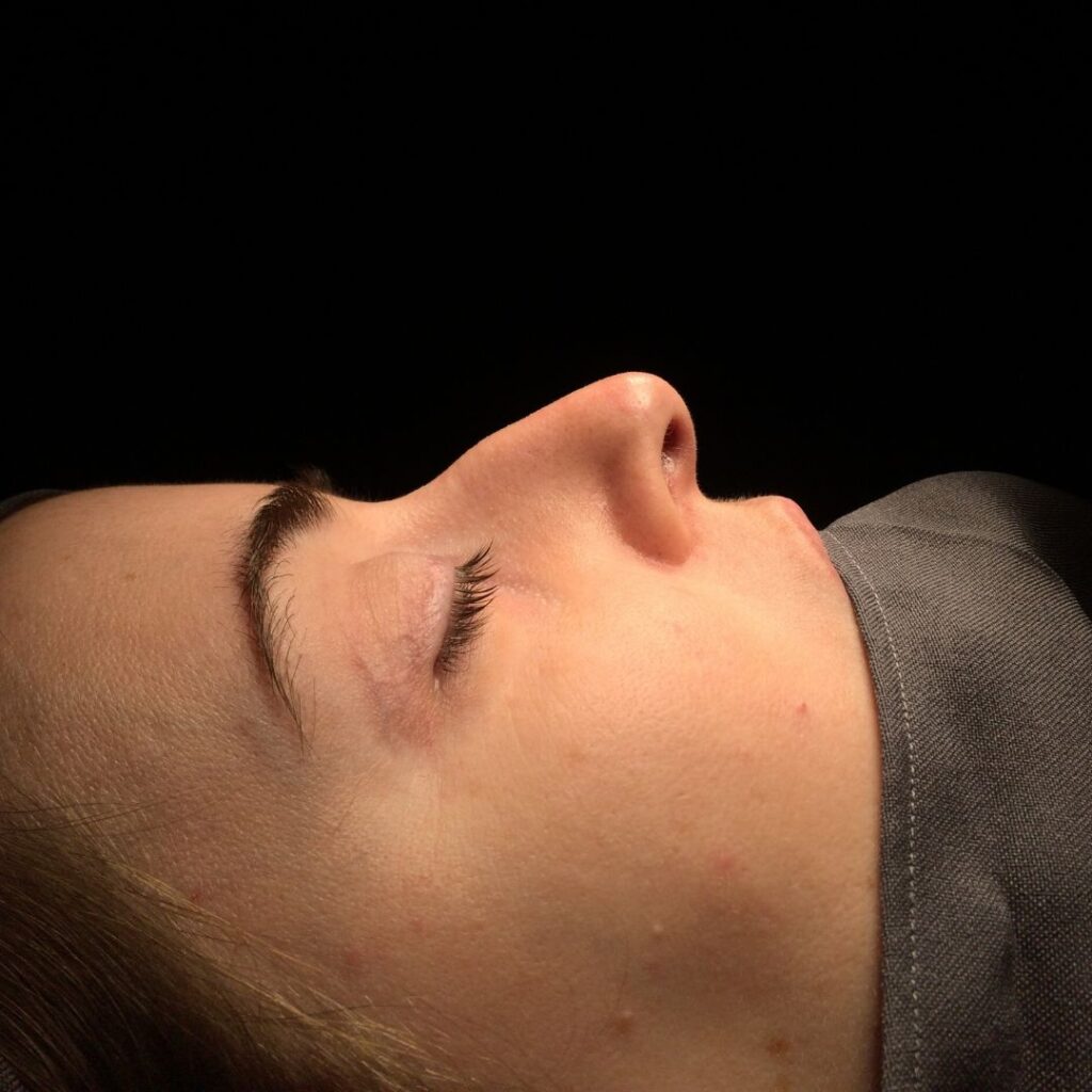 rinoplastia ultrasonica 28 antes